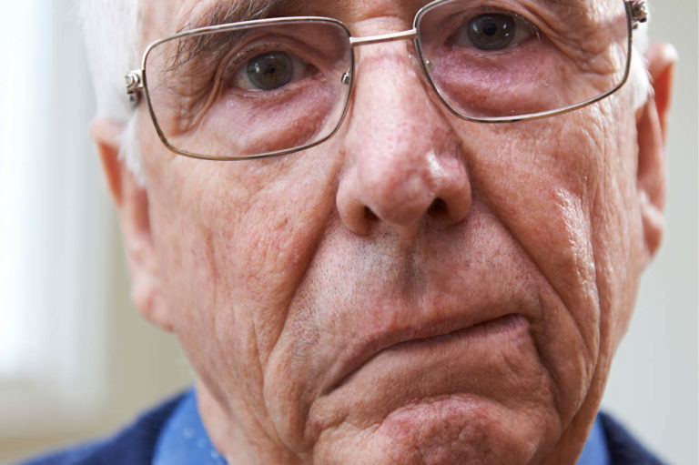 En eldre mann med halve ansiktet hengende nedover med hjerneslag